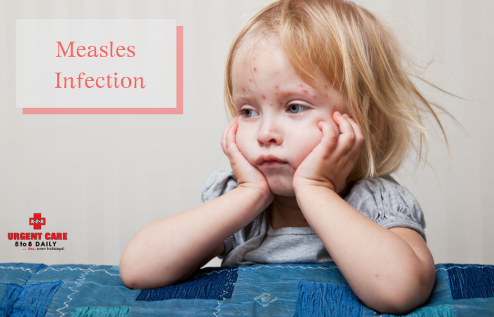Measles Infection: Symptoms, Causes, Treatment, & Prevention